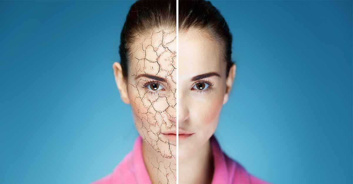 Dry Skin
