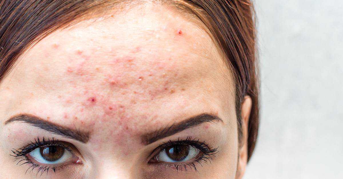 forehead acne
