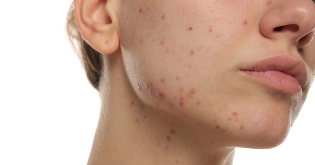 Close-up of a person's lower face and cheek with visible acne and red pimples on the skin.