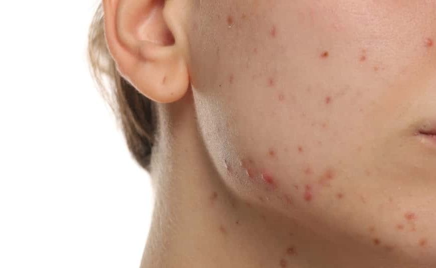 Close-up of a person's lower face and cheek with visible acne and red pimples on the skin.