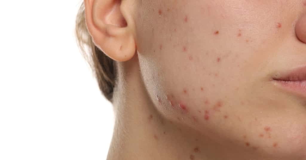 Close-up of a person's lower face and cheek with visible acne and red pimples on the skin.